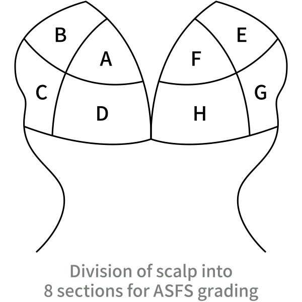 ASFS（adherent scalp flake score）評価法